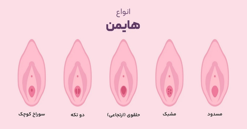 انواع پرده بکارت