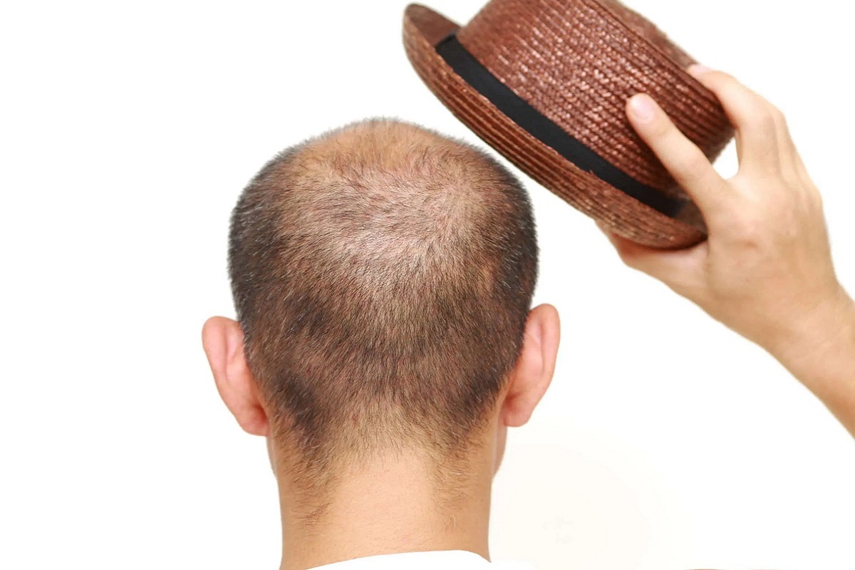 تاثیر پوشیدن کلاه در ریزش مو تاثیر پوشیدن کلاه در ریزش مو